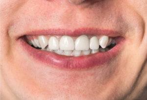 Teeth in a Day