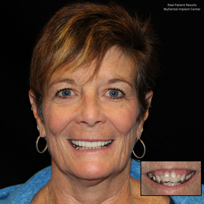 Full Mouth Dental Implants in Mesa